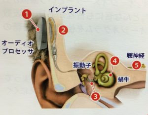 人工中耳
